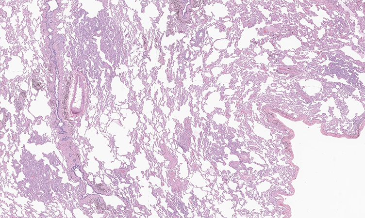 Small Bleb Pulmonary Pathology Society